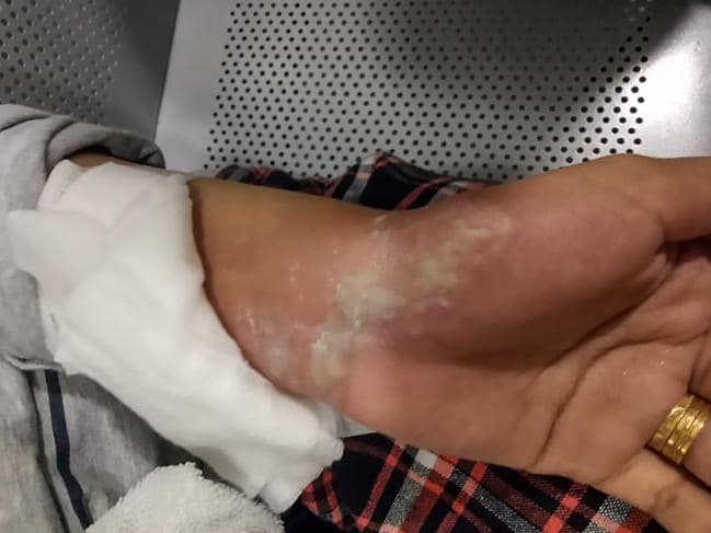 iPhone Explosion left A woman with serious burns