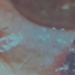 Doctors Find Four Live Bees Inside Womans Eye