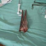 Needlefish out of the water and into boys neck