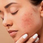 foods for acne pimples