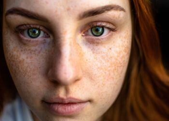 Home Remedies for Acne & Acne Scars